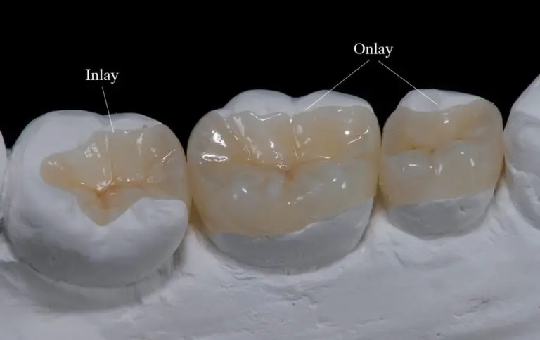 inlay and onlays - Dentist in Northridge