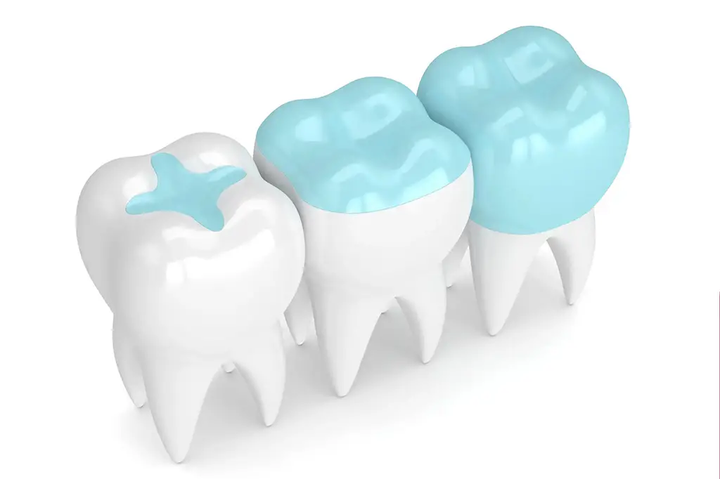 dental sealants