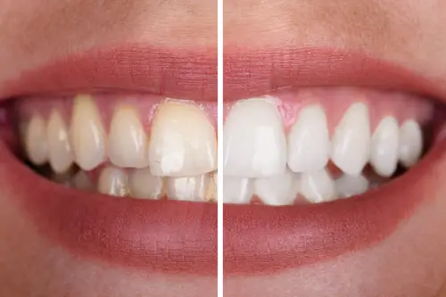 tooth whitening