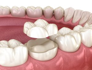dental crown