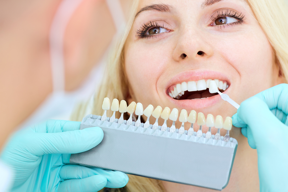 porcelain veneers