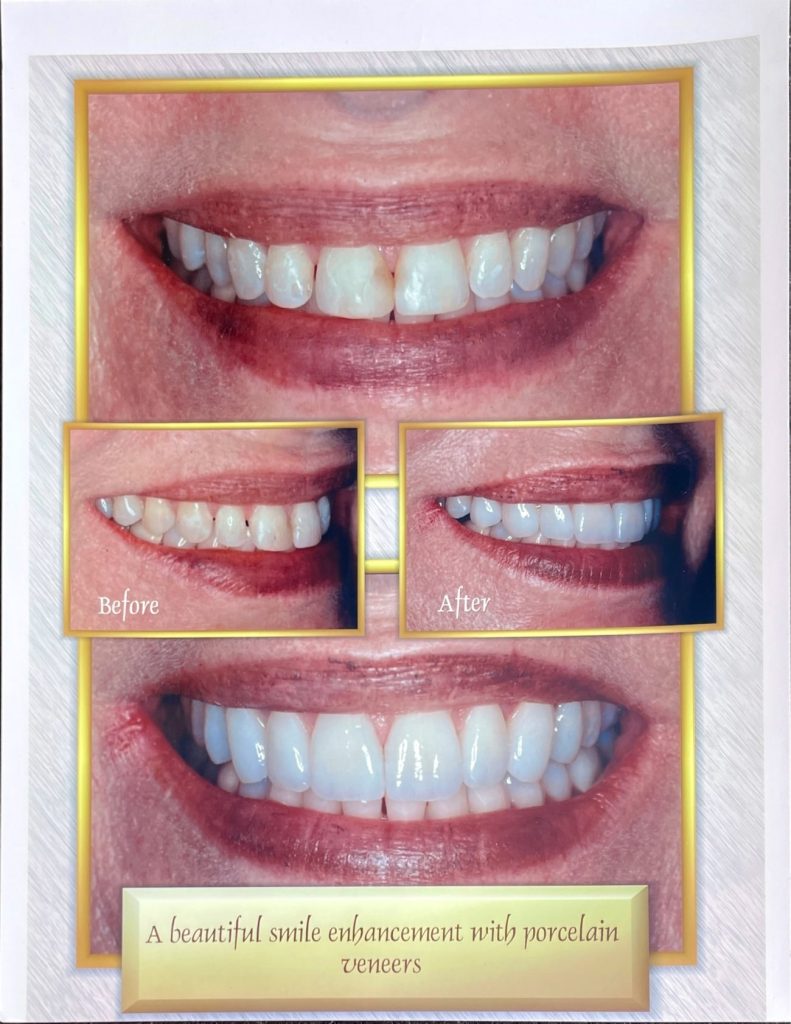 Before and after dental treatment with Dr. Gropp in Northridge