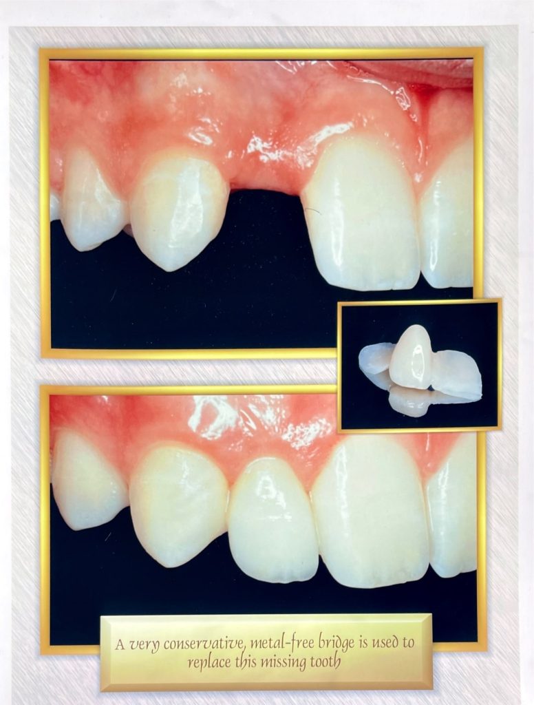Before and after dental treatment with Dr. Gropp - Northridge dental office